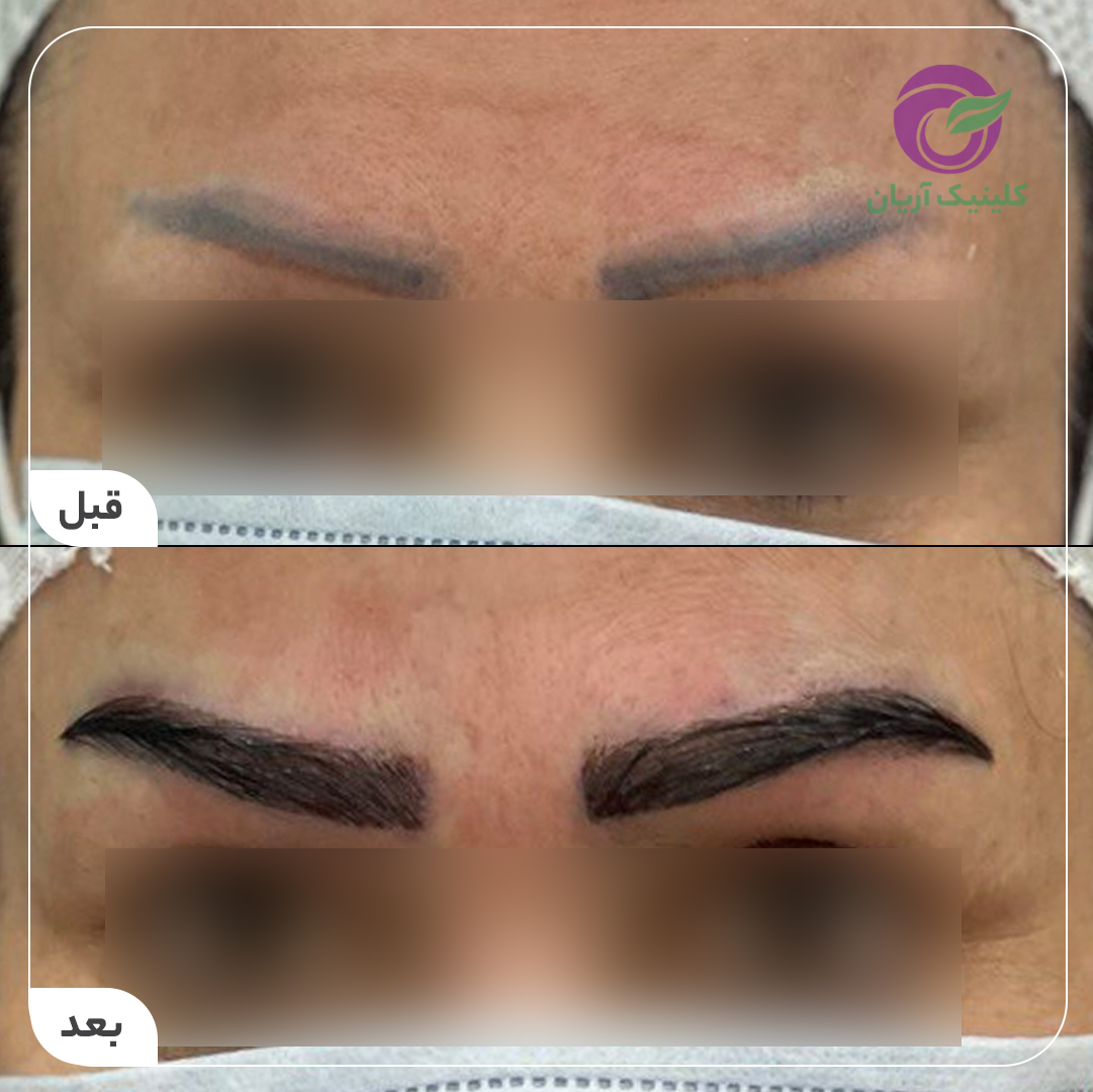 گالری فیلم کاشت ابرو